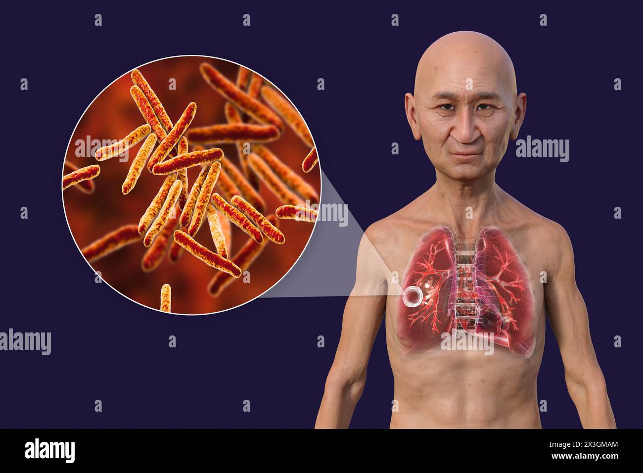 Illustration d'un homme aux poumons atteints de tuberculose caverneuse, et vue rapprochée des bactéries Mycobacterium tuberculosis. Banque D'Images