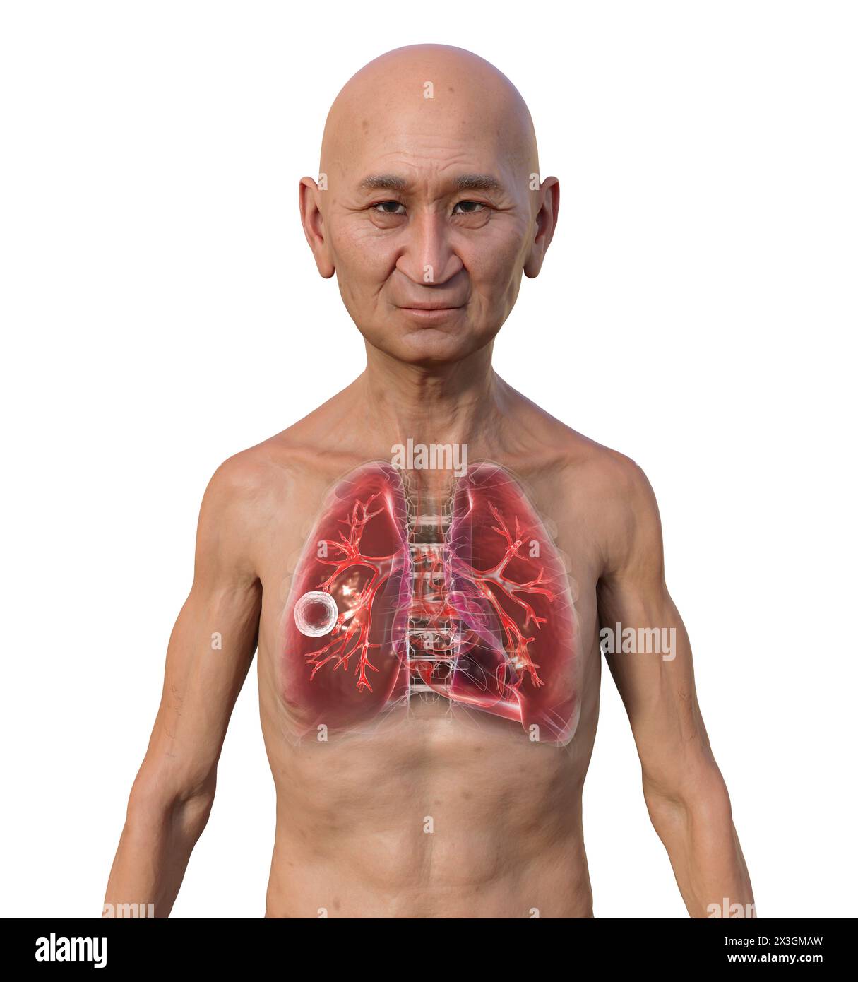 Illustration d'un homme aux poumons atteints de tuberculose caverneuse. Banque D'Images