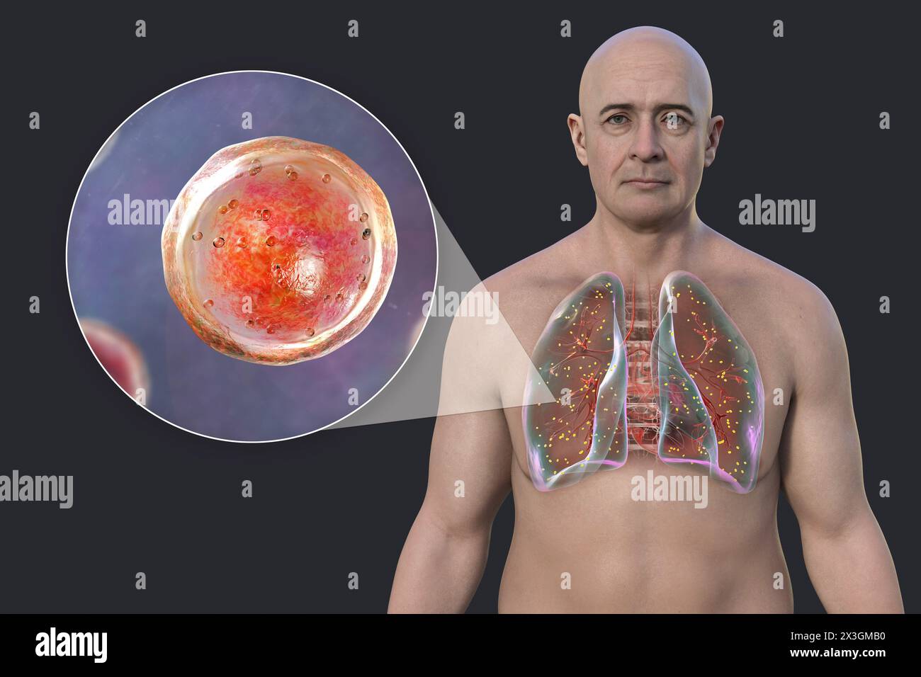 Illustration d'un homme atteint d'adiaspiromycose pulmonaire, une infection respiratoire causée par le champignon Emmonsia spp, caractérisée par la présence de spores fongiques encapsulées agrandies dans les tissus pulmonaires. Banque D'Images
