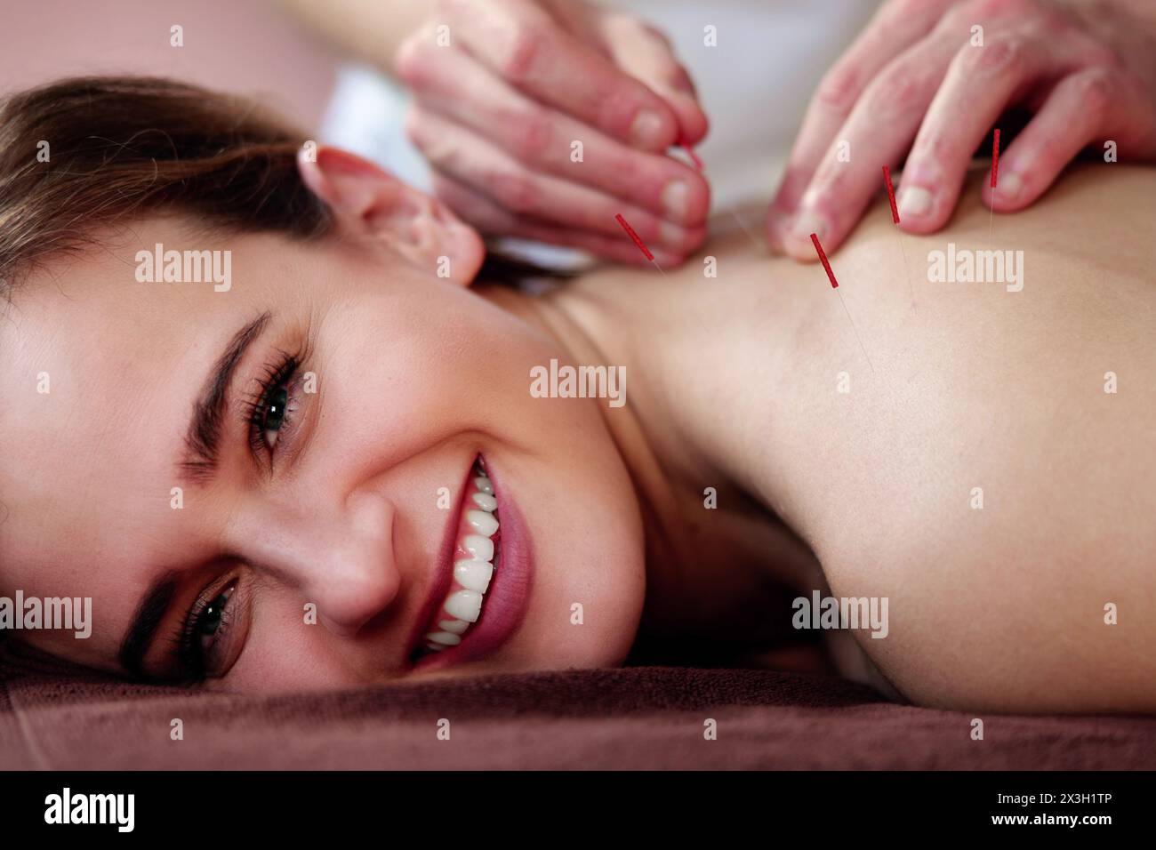 Thérapie d'acupuncture : soin de ventouse et de massage avec aiguilles sèches Banque D'Images