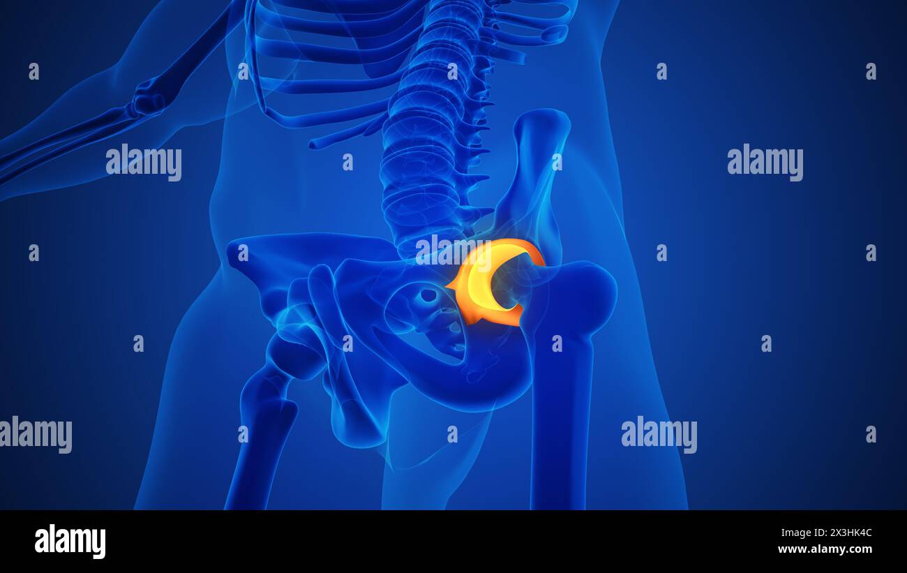 Squelette avec arthrose traumatique de l'articulation de la hanche Banque D'Images