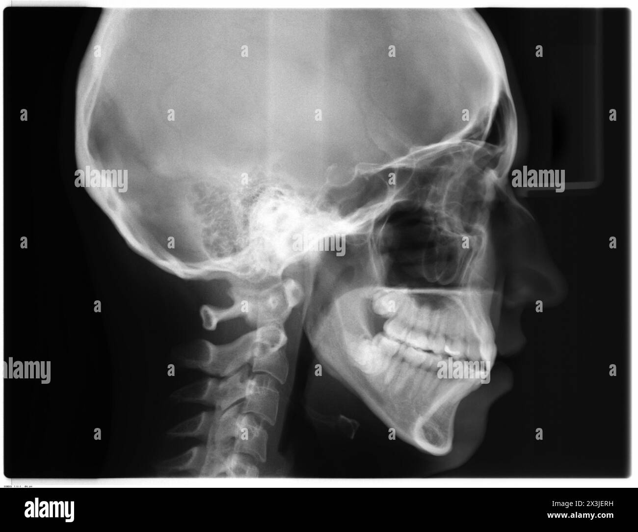 Image radiographique de la vue latérale du crâne (latérale, LAT). Crâne, mâchoire et cou humains sur fond noir. Tête de femme. Banque D'Images Image radiographique de la vue latérale du crâne (latérale, LAT). Crâne, mâchoire et cou humains sur fond noir. Tête de femme. Banque D'Images