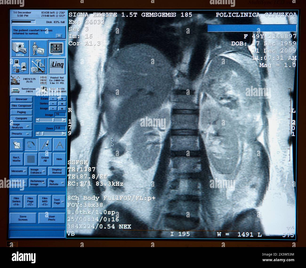 Abdomen : foie, rate, reins et colonne vertébrale, IRM (imagerie par résonance magnétique), imagerie médicale pour le diagnostic. Hôpital Policlinica Gipuzkoa, San Sebasti Banque D'Images