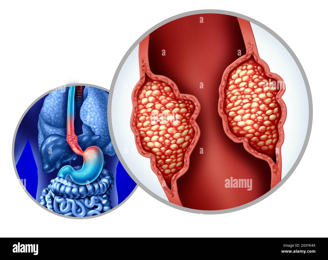 Cancer de l'œsophage ou carcinome de l'œsophage comme adénocarcinome mutant la croissance des cellules à l'intérieur du système digestif comme une tumeur croissante de gros plan. Banque D'Images