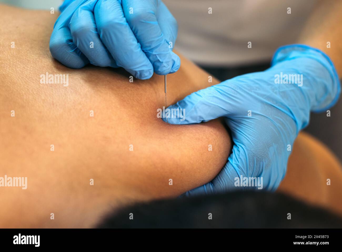 Gros plan d'un professionnel de la santé traitant un patient en utilisant la procédure d'aiguilletage à sec dans une clinique de physiothérapie et de récupération musculaire. Banque D'Images