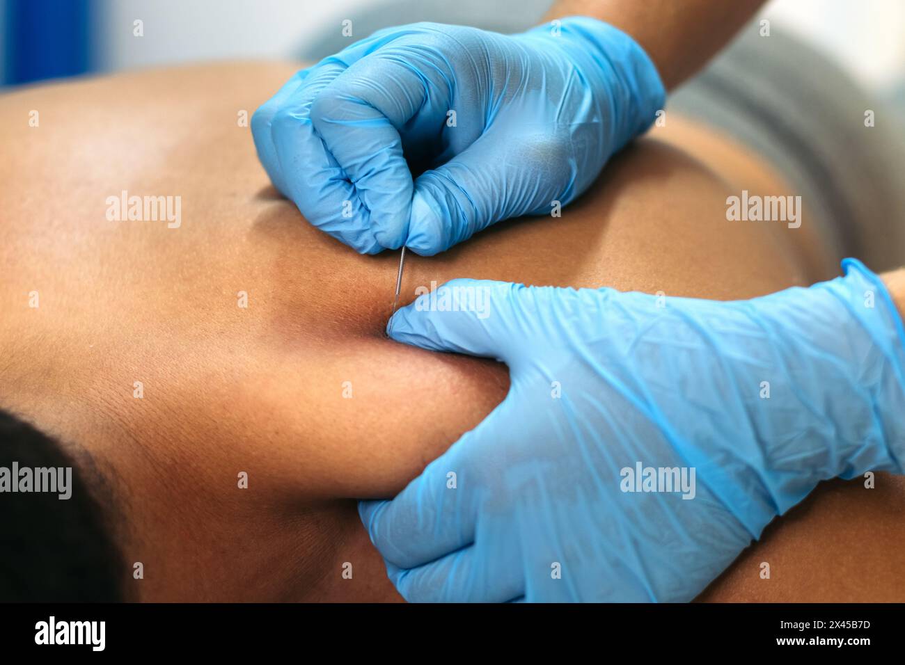 Gros plan d'un professionnel de la santé traitant un patient en utilisant la procédure d'aiguilletage à sec dans une clinique de physiothérapie et de récupération musculaire. Banque D'Images