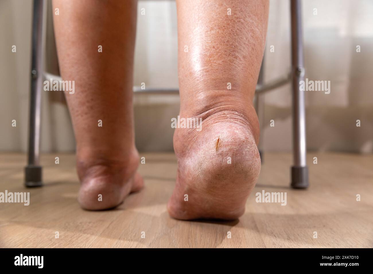 La jambe de la femme est oedème (gonflement) après le traitement du cancer. Banque D'Images
