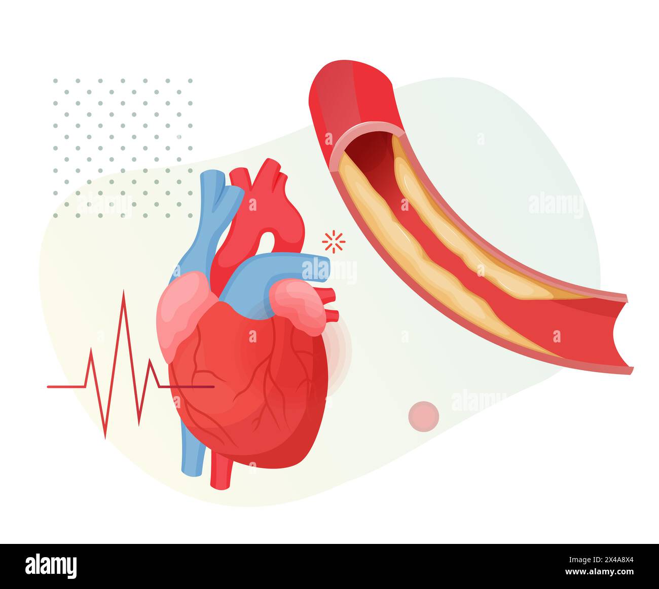 Stades d'athérosclérose - accumulation de plaque de cholestérol dans le cœur - illustration stock en tant que fichier EPS 10 Illustration de Vecteur