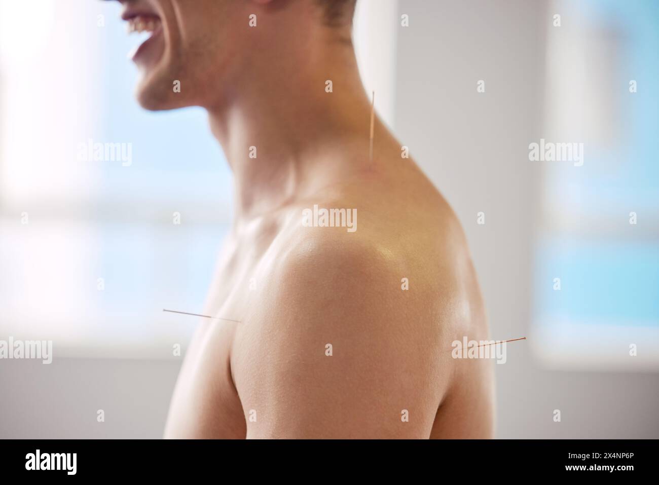 Acupuncture, l'homme et le traitement du corps pour les soins de santé, la guérison musculaire ou le soulagement des maux de dos. Heureux, patient et physiothérapie avec aiguilletage sec à Banque D'Images