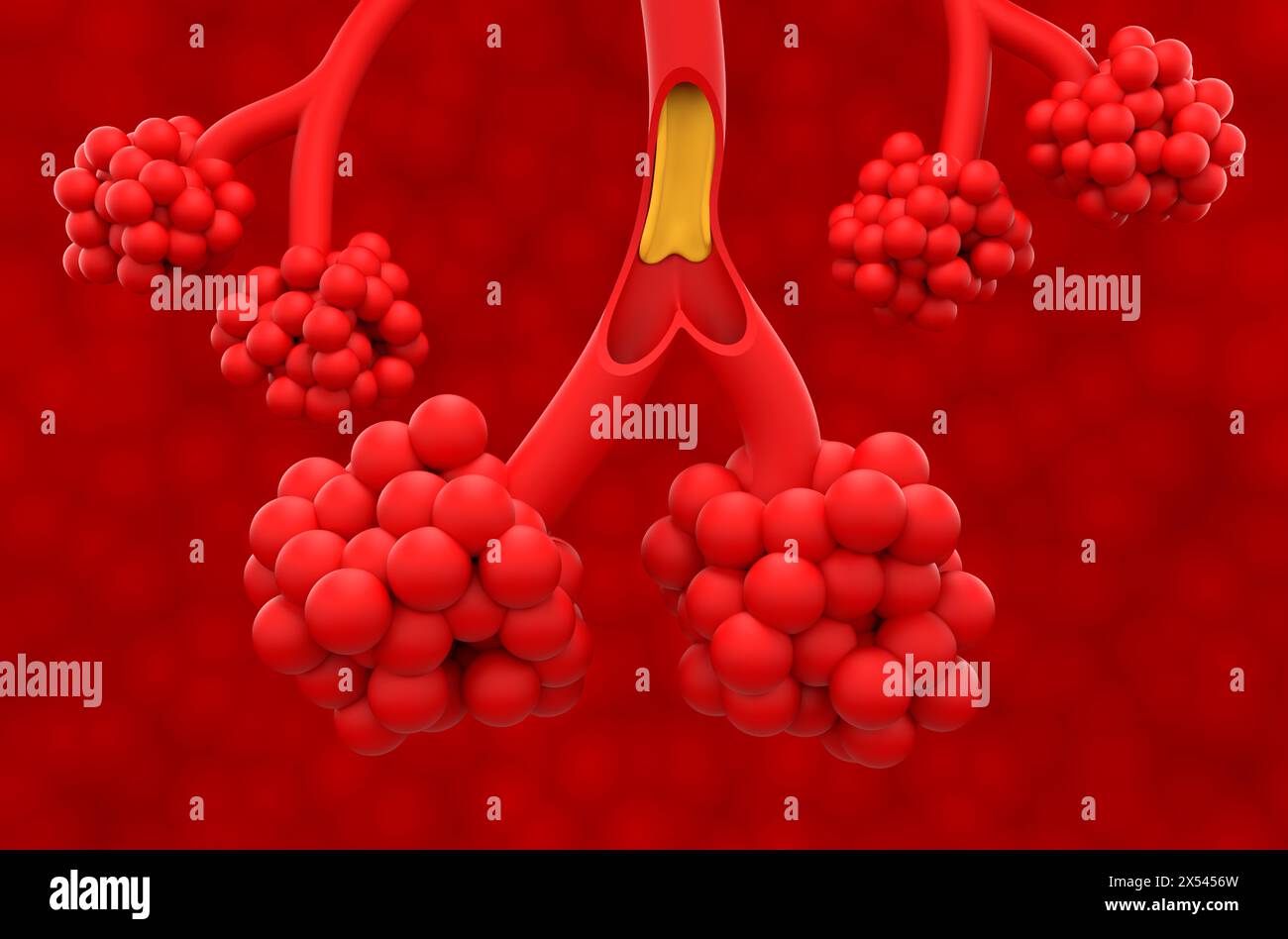Mucoviscidose (CF) - vue isométrique illustration 3D. Banque D'Images