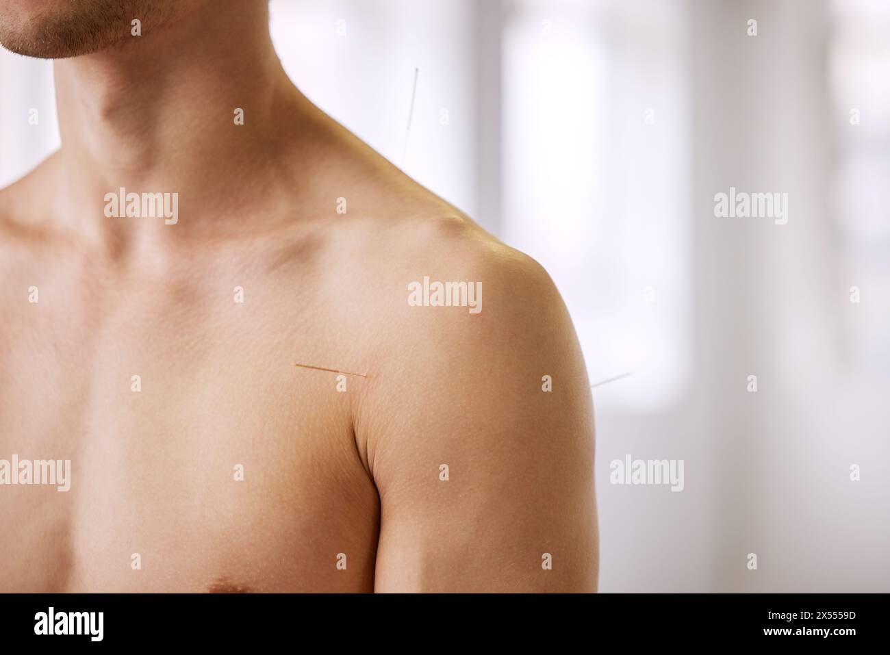 Acupuncture, l'homme et le traitement du corps pour les soins de santé, la guérison musculaire ou le soulagement des maux de dos. Sain, patient et physiothérapie avec aiguilletage sec Banque D'Images