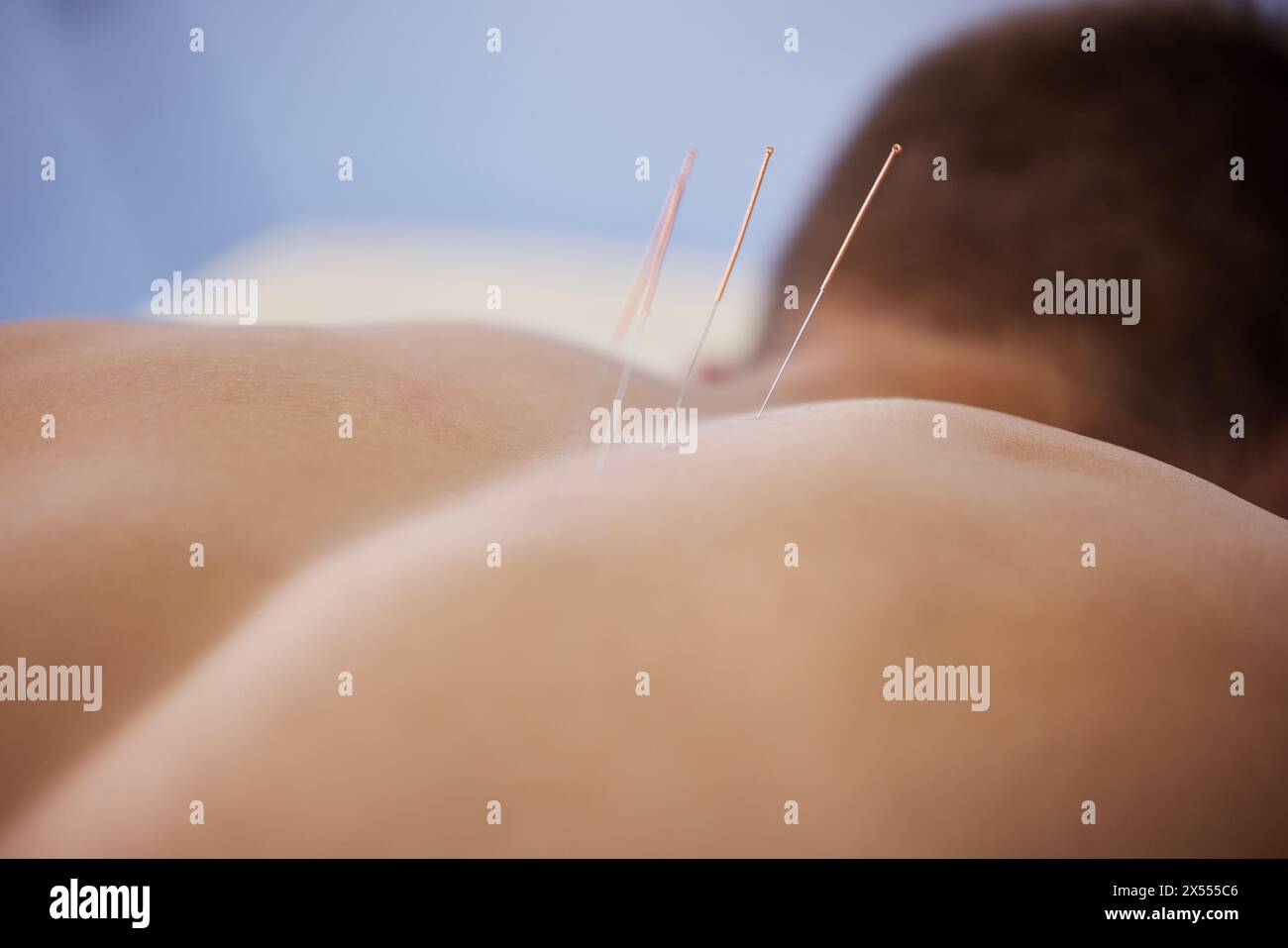 Acupuncture, aiguilles et traitement de guérison du corps dans les soins de santé wirth douleur de dos, blessure ou soulagement dans le muscle. Clinique, patient et physiothérapie sec Banque D'Images