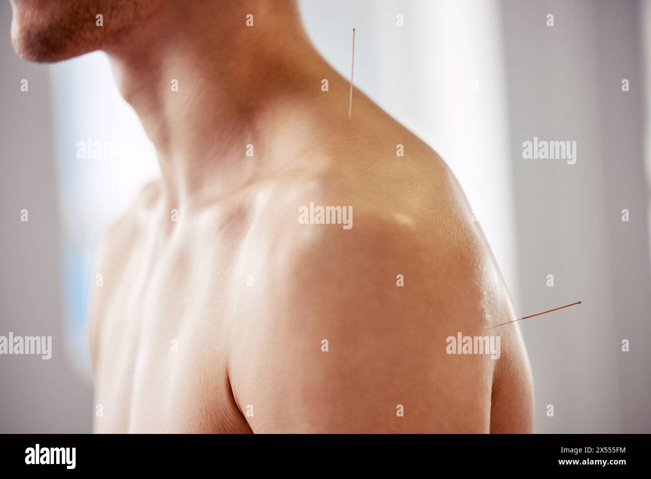 Acupuncture, homme et traitement des aiguilles pour les soins de santé, la guérison musculaire ou le soulagement des maux de dos. Spa, client et physiothérapie avec aiguilletage sec Banque D'Images