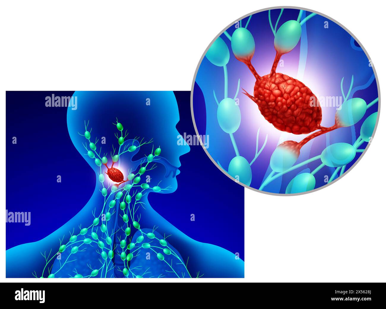 Ganglion lymphatique gonflé comme une glande infectée du système lymphatique et le système immunitaire comme un gonflement de l'organe lymphoïde infecté par une bactérie ou un virus. Banque D'Images