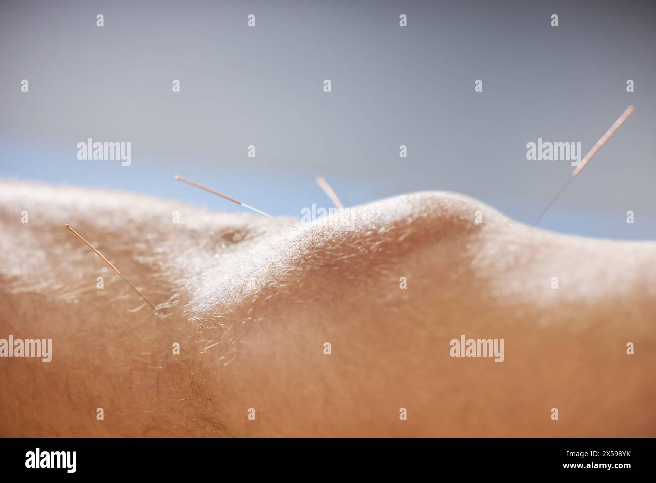 Acupuncture, genou et traitement du corps dans les soins de santé, cicatrisation musculaire et soulagement de la douleur. Sain, patient et physiothérapie avec aiguilletage sec à Banque D'Images