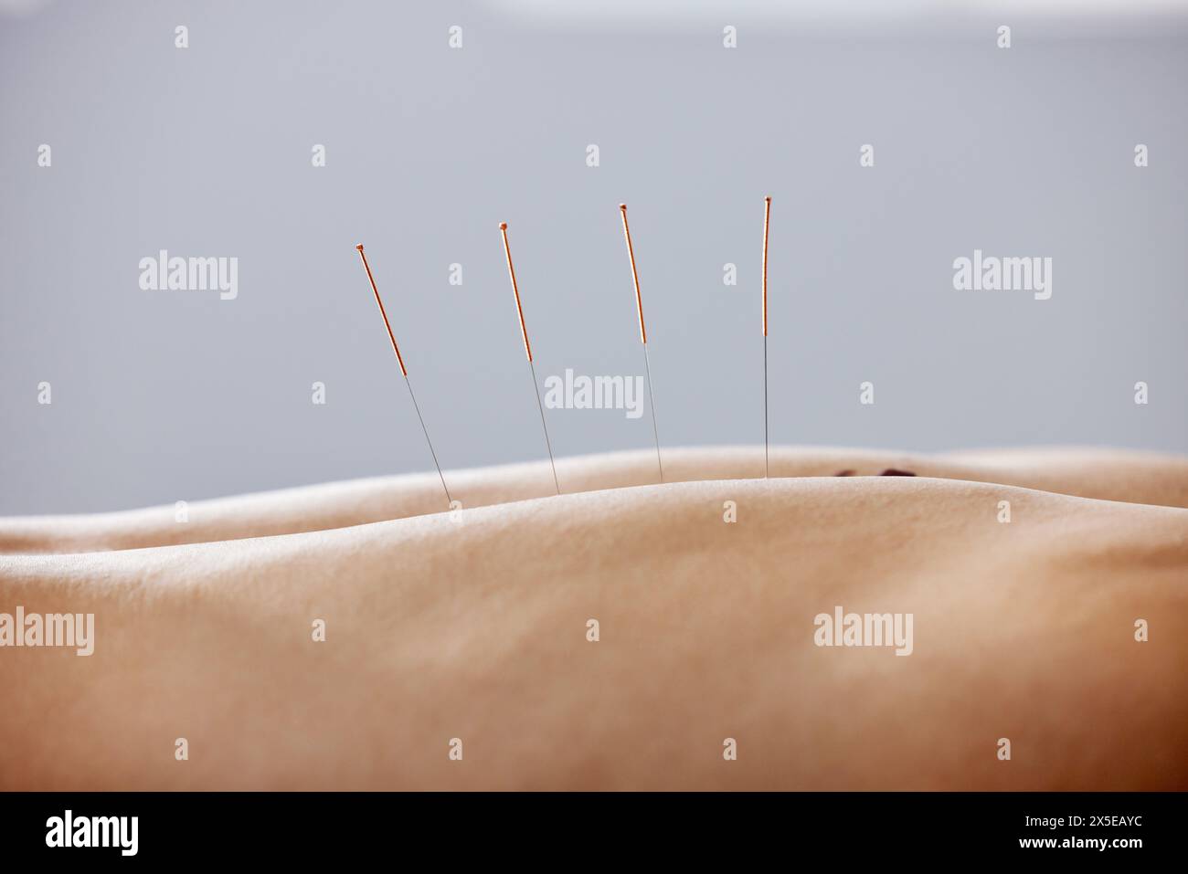 Acupuncture, aiguilles et traitement du corps dans les soins de santé, le muscle de guérison et le soulagement des douleurs dorsales. Patient, anatomie et aiguille sèche physiothérapie à Banque D'Images