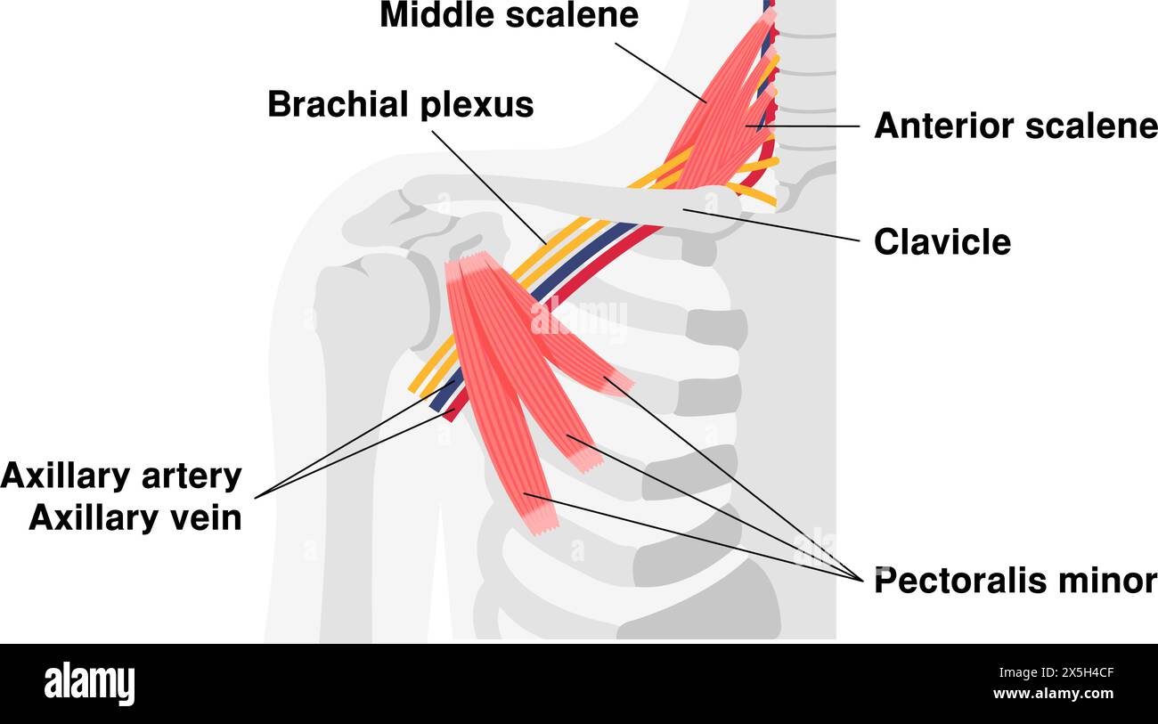 Illustration vectorielle de l'endroit où se produit le syndrome du défilé thoracique Illustration de Vecteur Illustration vectorielle de l'endroit où se produit le syndrome du défilé thoracique Illustration de Vecteur