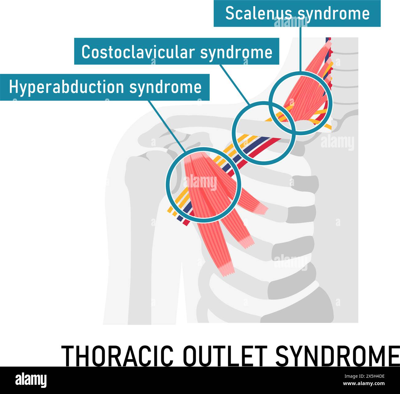 Illustration vectorielle de l'endroit où se produit le syndrome du défilé thoracique Illustration de Vecteur Illustration vectorielle de l'endroit où se produit le syndrome du défilé thoracique Illustration de Vecteur