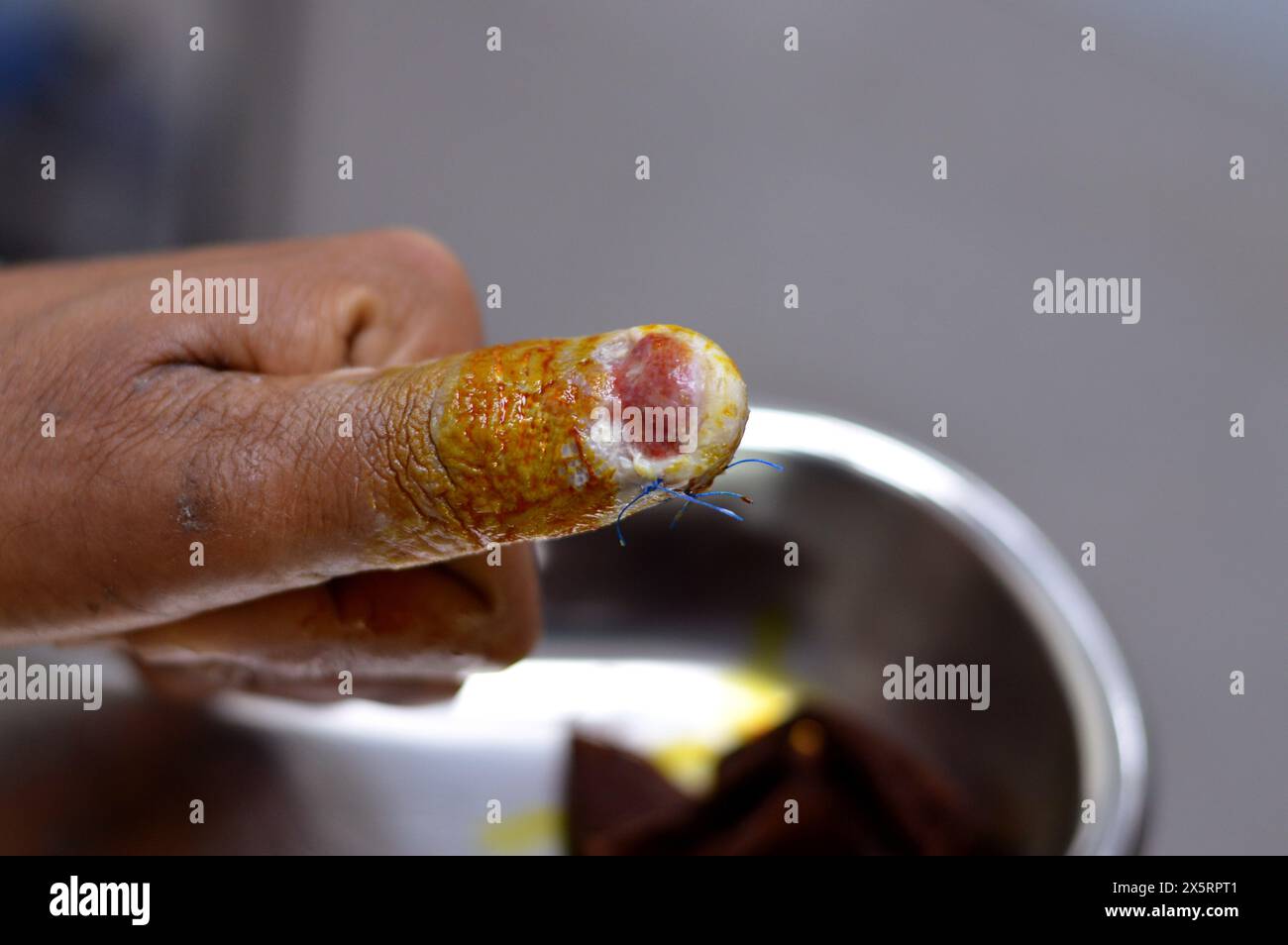 un pouce de la main gauche avec ablation chirurgicale de l'ongle du pouce, et des points de suture d'une plaie coupée après un traumatisme direct au doigt qui a causé des dommages o Banque D'Images