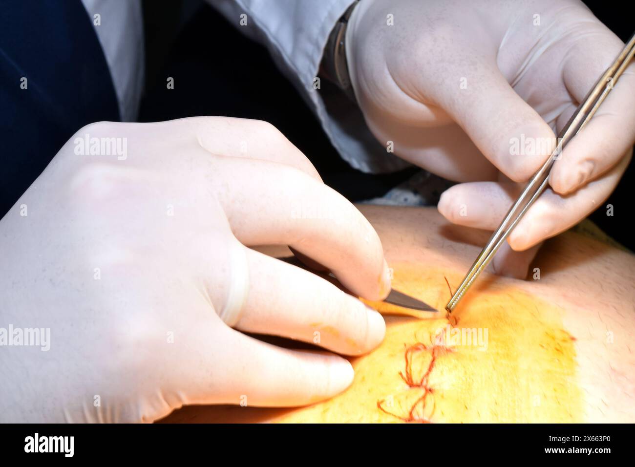Les mains d'un chirurgien qui utilise une pince à épiler et un scalpel pour enlever les fils d'une suture sur l'estomac du patient. Banque D'Images