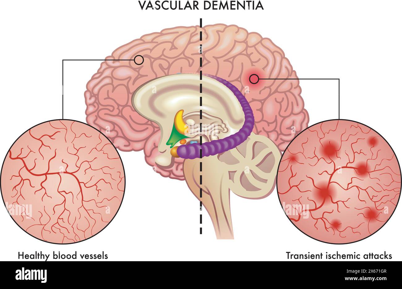 L'illustration médicale compare les vaisseaux sanguins sains du cerveau, avec d'autres affectés par des crises ischémiques transitoires qui sont l'une des causes de va Illustration de Vecteur