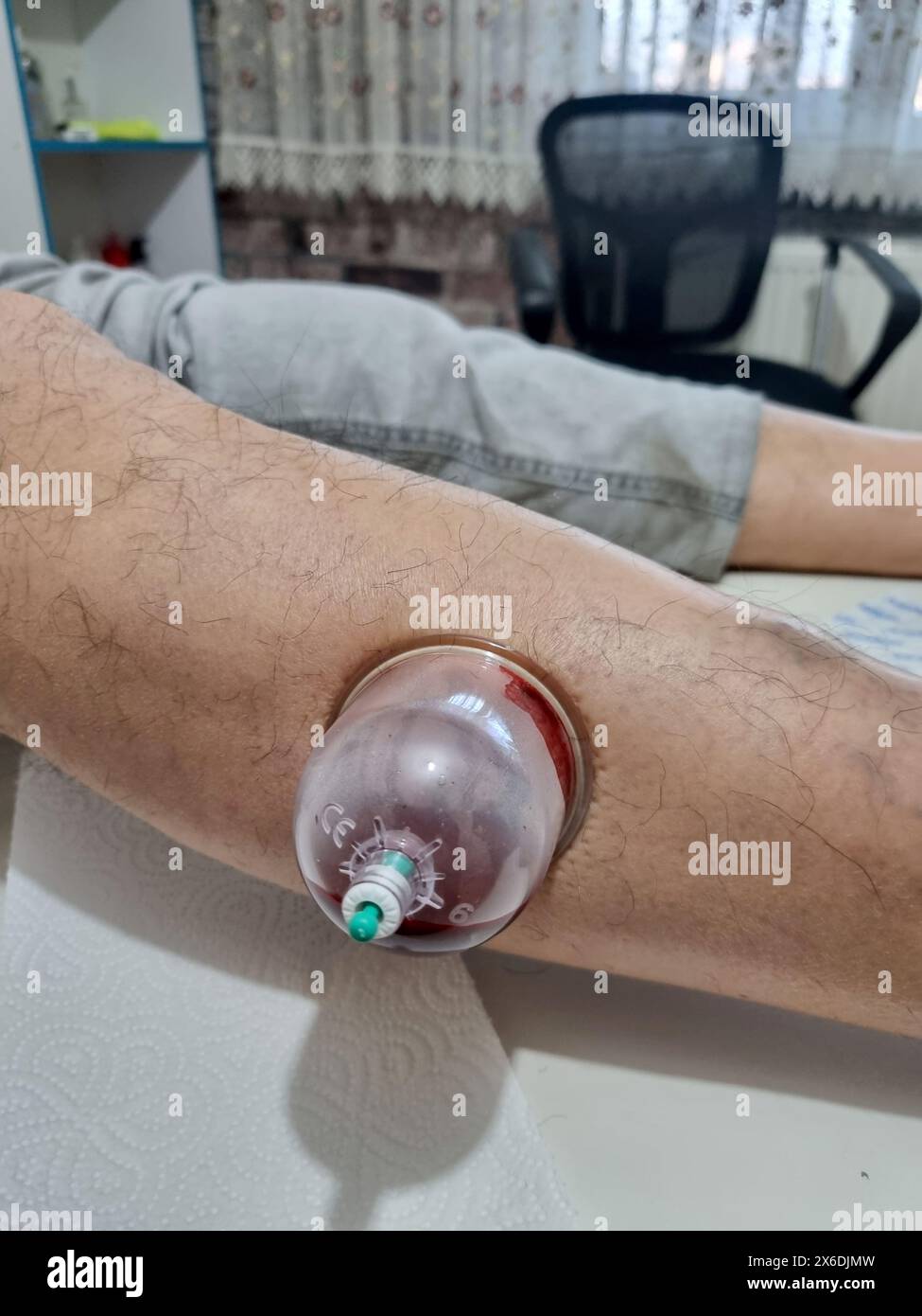 La thérapie des sangsues sur les jambes est une méthode utilisée en médecine traditionnelle. Banque D'Images