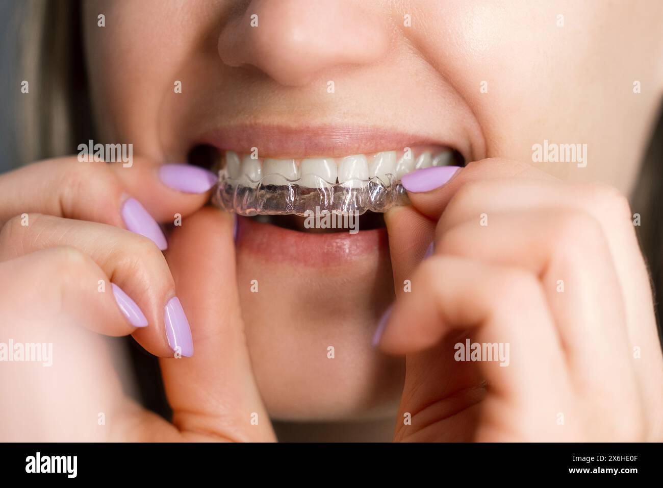 femme insérant des aligneurs dentaires invisibles transparents pour le redressement des dents Banque D'Images