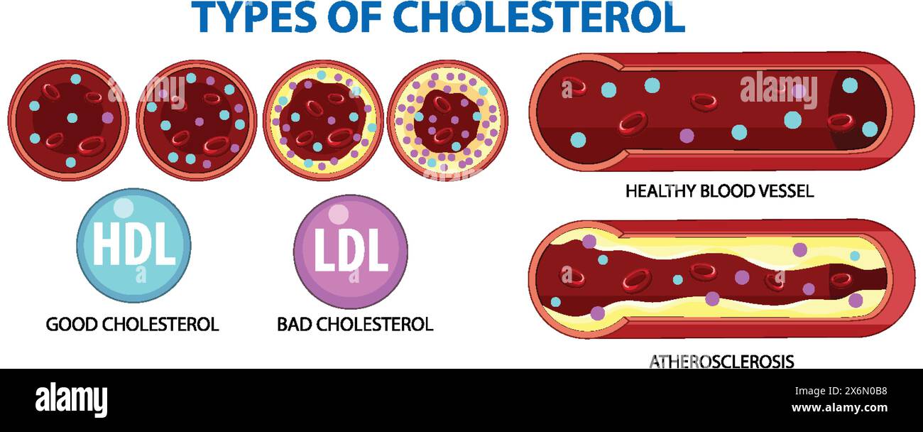 Illustration des HDL, LDL et athérosclérose dans les vaisseaux sanguins Illustration de Vecteur