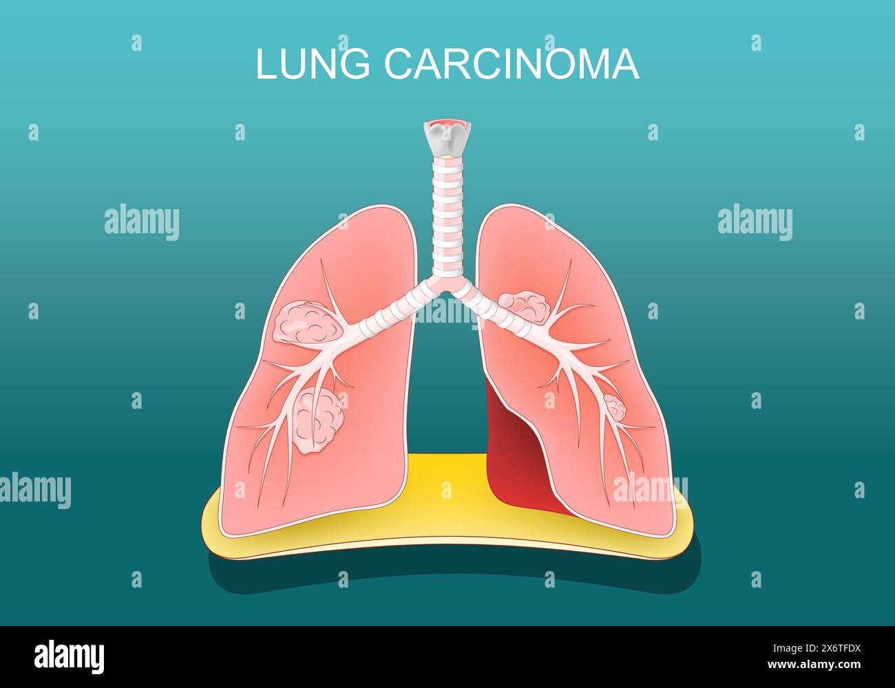 Carcinome pulmonaire. Cancer du poumon. Les tumeurs métastasent, se propageant à d'autres parties du corps. Affiche vectorielle. Illustration plate isométrique. Illustration de Vecteur