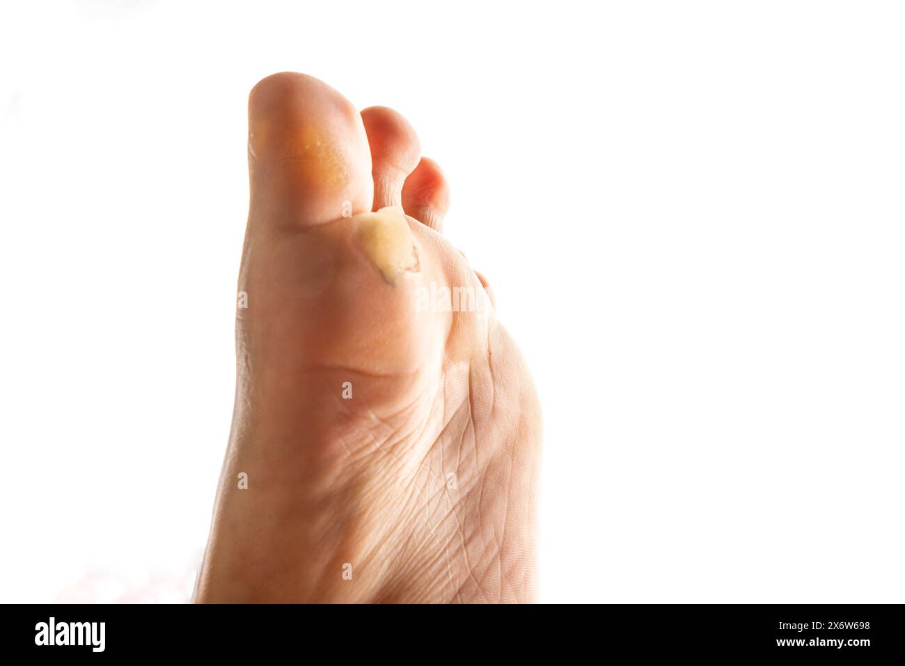Pied avec peau sèche sur le talon et la semelle. pieds masculins, avec la peau rugueuse et fissurée isolé sur fond blanc, gros plan, image de l'espace de copie pour un usage médical. Banque D'Images