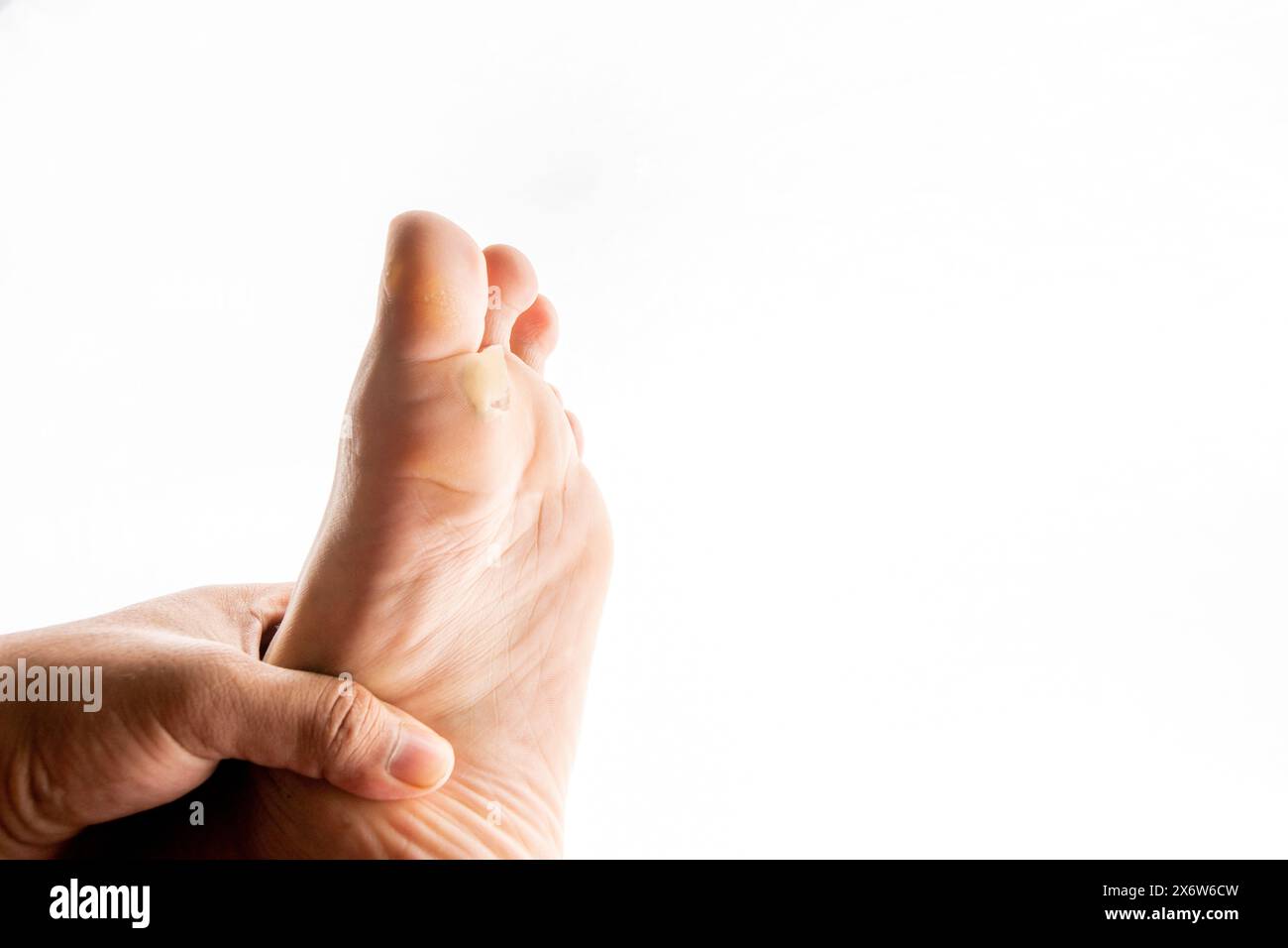 pied avec un cal, peau qui se décolle du bas du pied Banque D'Images