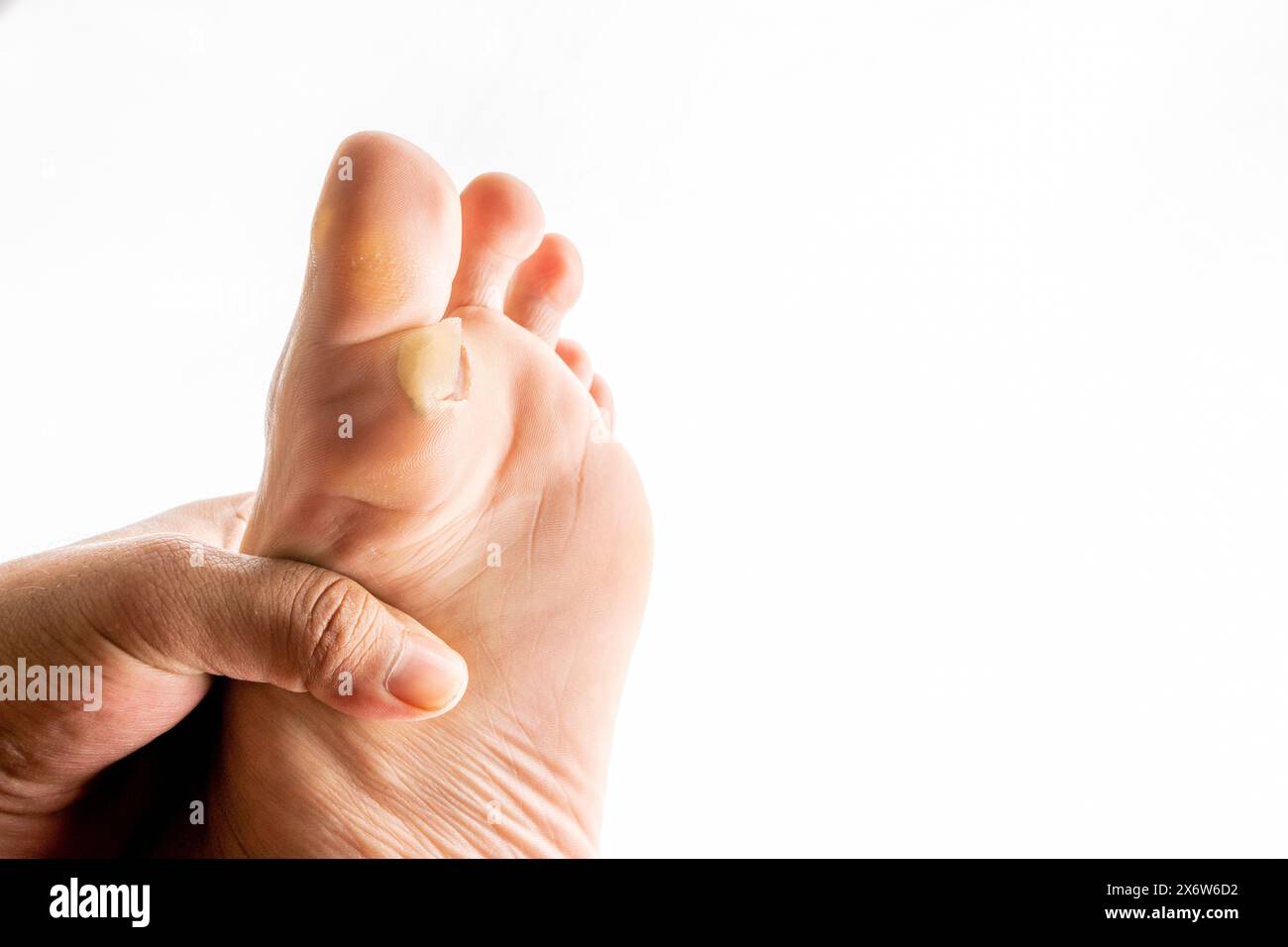 Pied avec peau sèche sur le talon et la semelle. pieds masculins, avec la peau rugueuse et fissurée isolé sur fond blanc, gros plan, image de l'espace de copie pour un usage médical. Banque D'Images
