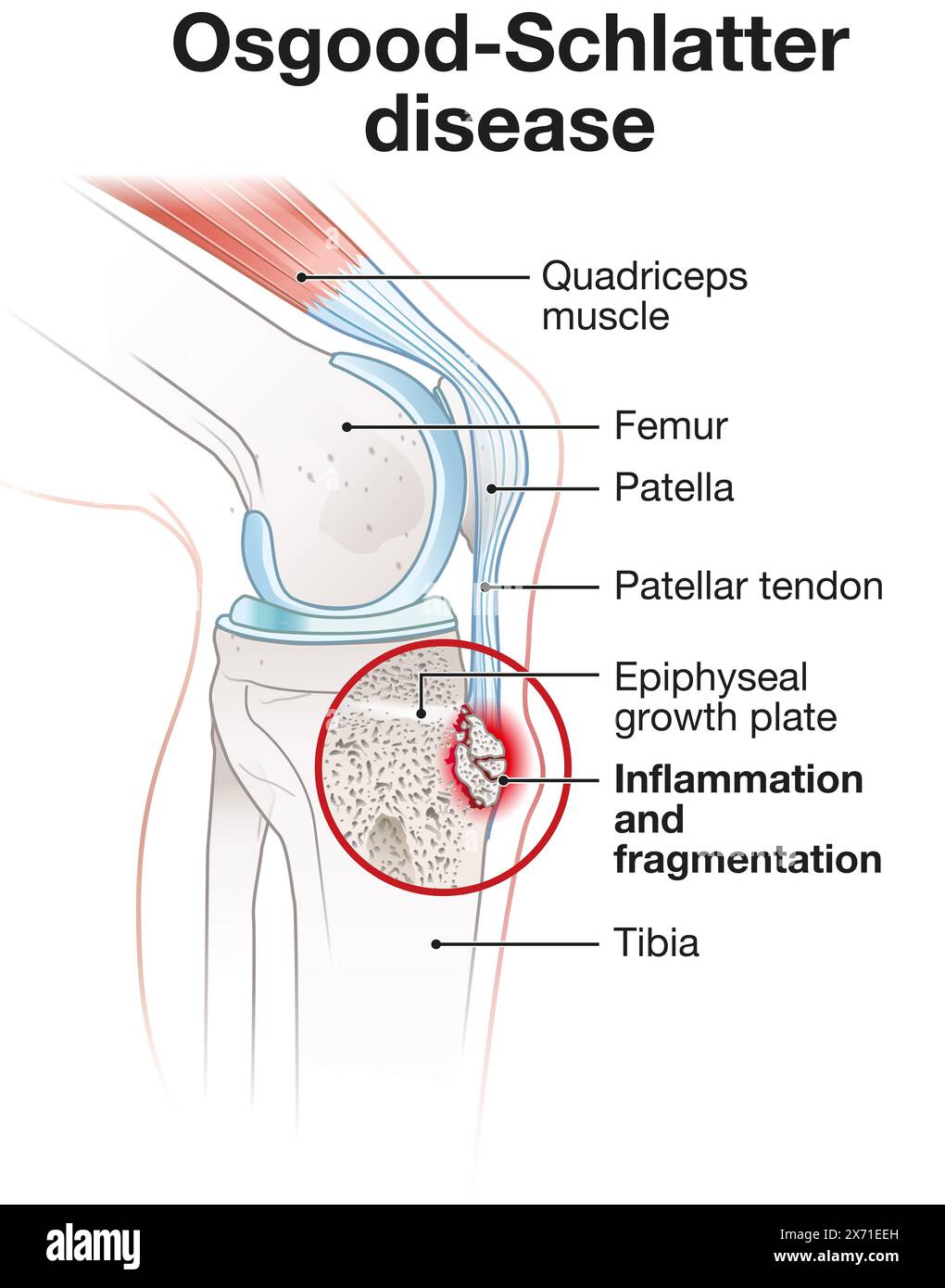 La maladie d'Osgood-Schlatter provoque des douleurs au genou et un gonflement au niveau de la tubérosité tibiale, souvent chez les adolescents en raison de la croissance rapide et de l'activité physique. Banque D'Images La maladie d'Osgood-Schlatter provoque des douleurs au genou et un gonflement au niveau de la tubérosité tibiale, souvent chez les adolescents en raison de la croissance rapide et de l'activité physique. Banque D'Images