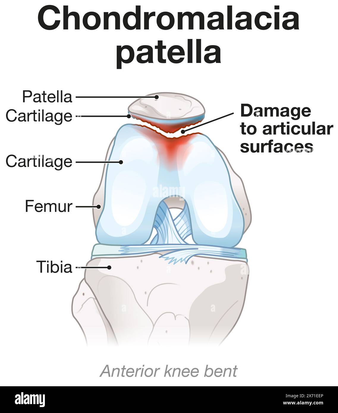 La chondromalacie implique le ramollissement et la détérioration du cartilage, causant souvent des douleurs au genou, une inflammation et un inconfort pendant les mouvements et les activités Banque D'Images