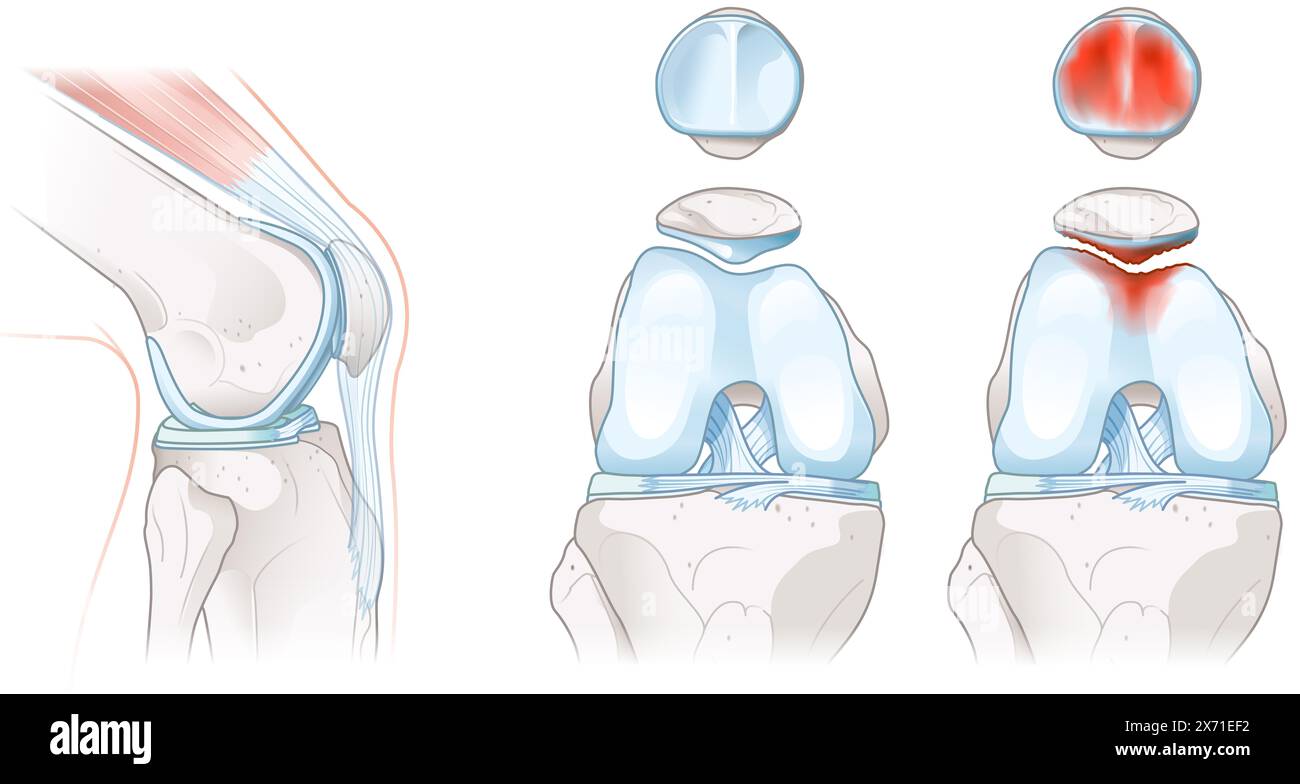 La chondromalacie implique le ramollissement et la détérioration du cartilage, causant souvent des douleurs au genou, une inflammation et un inconfort pendant les mouvements et les activités Banque D'Images