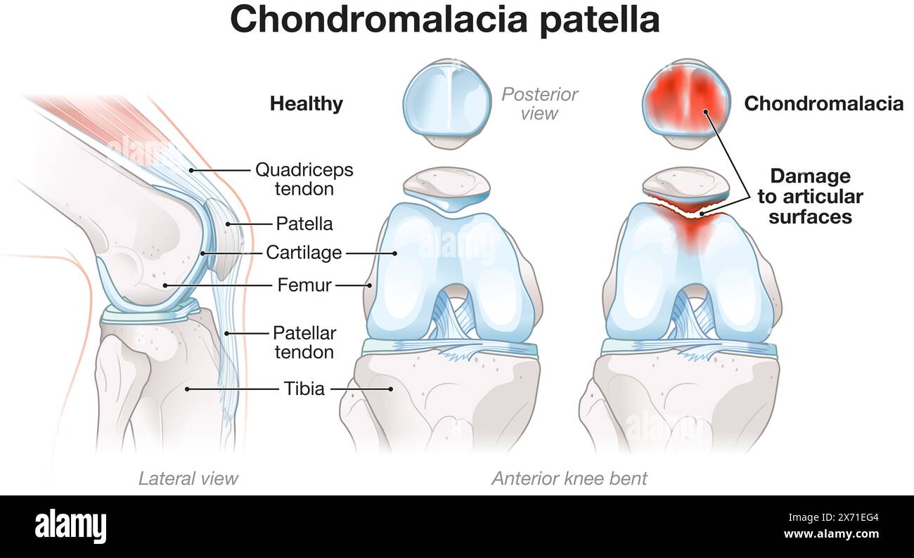 La chondromalacie implique le ramollissement et la détérioration du cartilage, causant souvent des douleurs au genou, une inflammation et un inconfort pendant les mouvements et les activités Banque D'Images