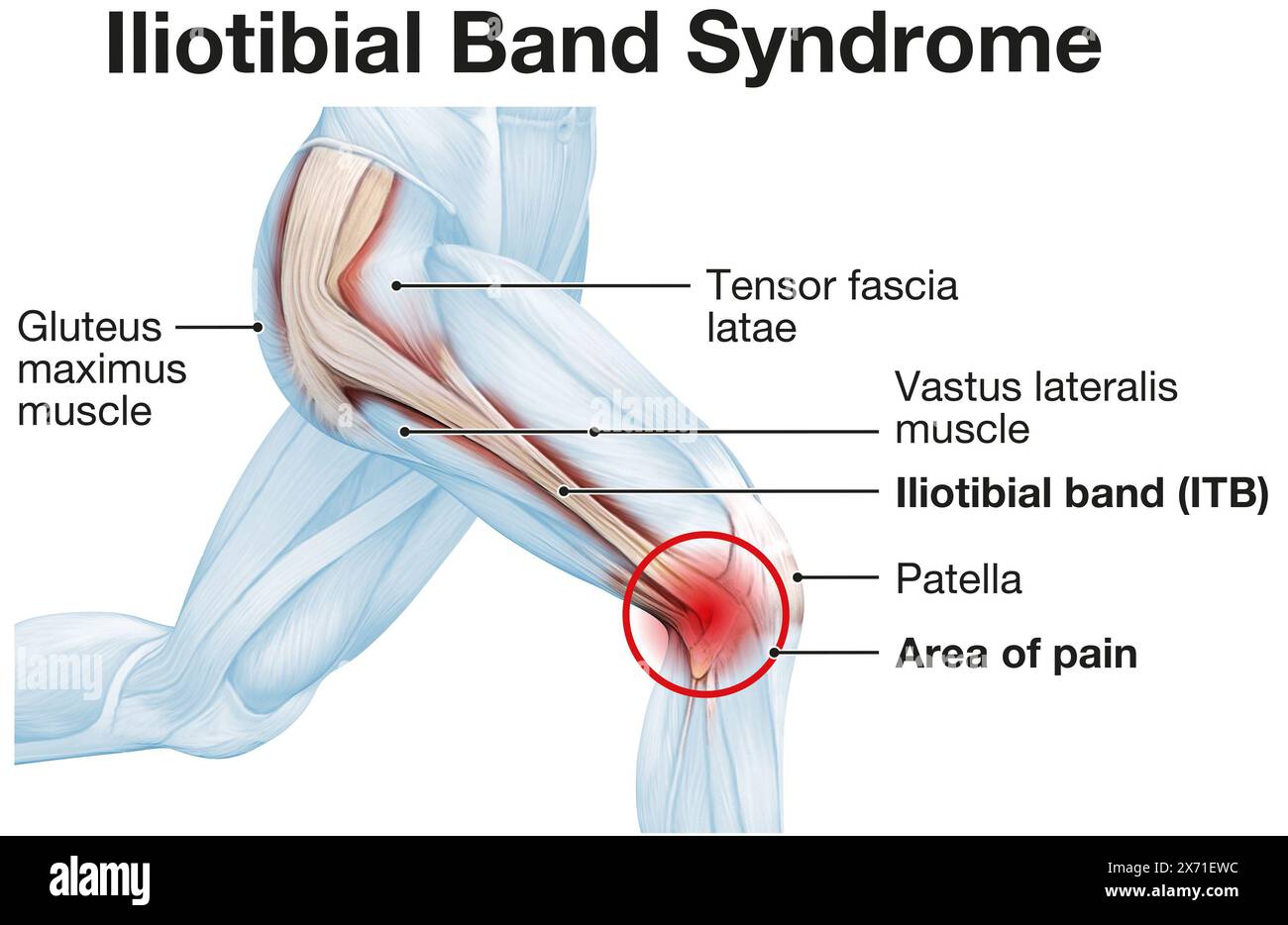 Syndrome de la bande iliotibiale : état du genou causant des douleurs à l'extérieur du genou en raison d'une inflammation ou d'une surutilisation Banque D'Images