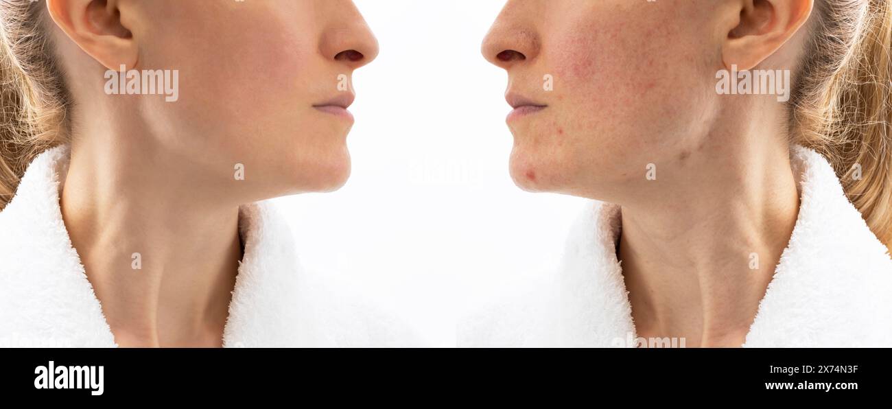 Avant et après le traitement de l'acné cutanée. Visage de femme dans ses 30 ans avec problème d'acné, couperosis, cicatrisation, Blackheads. Problème cutané de l'adulte. Cosmétiques et Banque D'Images