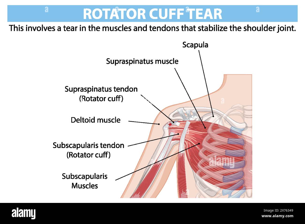 Anatomie détaillée de la déchirure de la coiffe des rotateurs de l'épaule Illustration de Vecteur