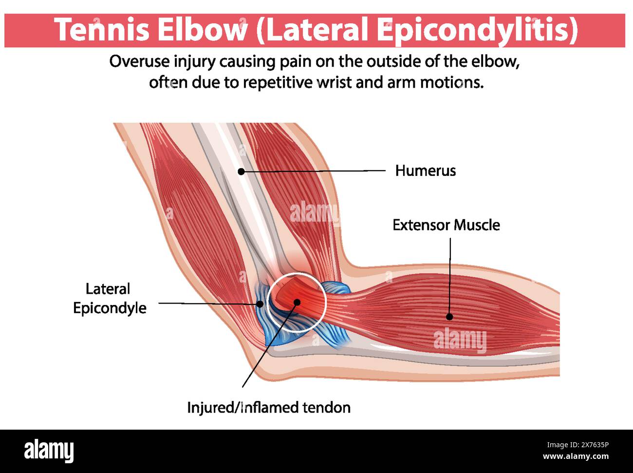 Illustration des blessures au coude de tennis et des zones affectées Illustration de Vecteur