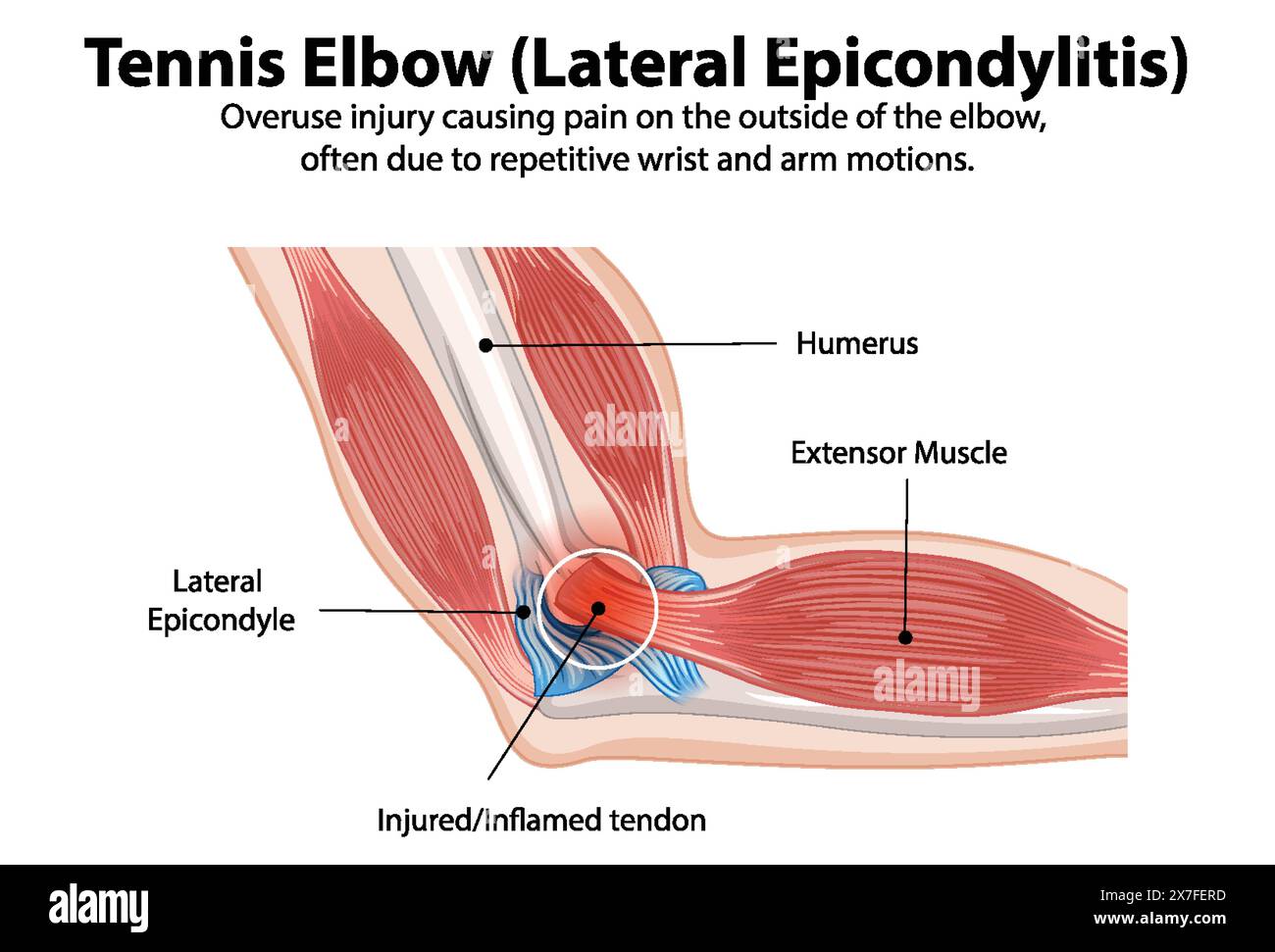 Schéma détaillé de l'état du tennis elbow Illustration de Vecteur