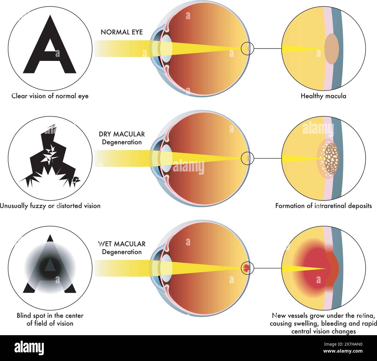 L'illustration médicale montre un œil sain et des symptômes affectant un œil affecté par une maculopathie sèche et humide, avec des annotations. Illustration de Vecteur