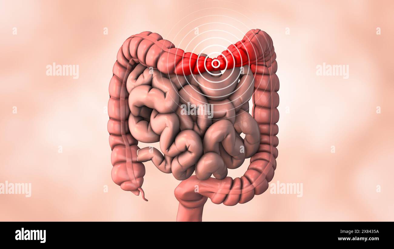 Mal d'estomac causé par une affection intestinale Banque D'Images