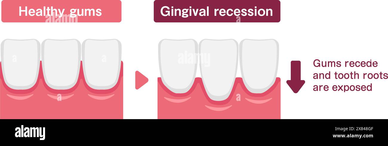 Illustration vectorielle de gencives saines et de récession gingivale Illustration de Vecteur