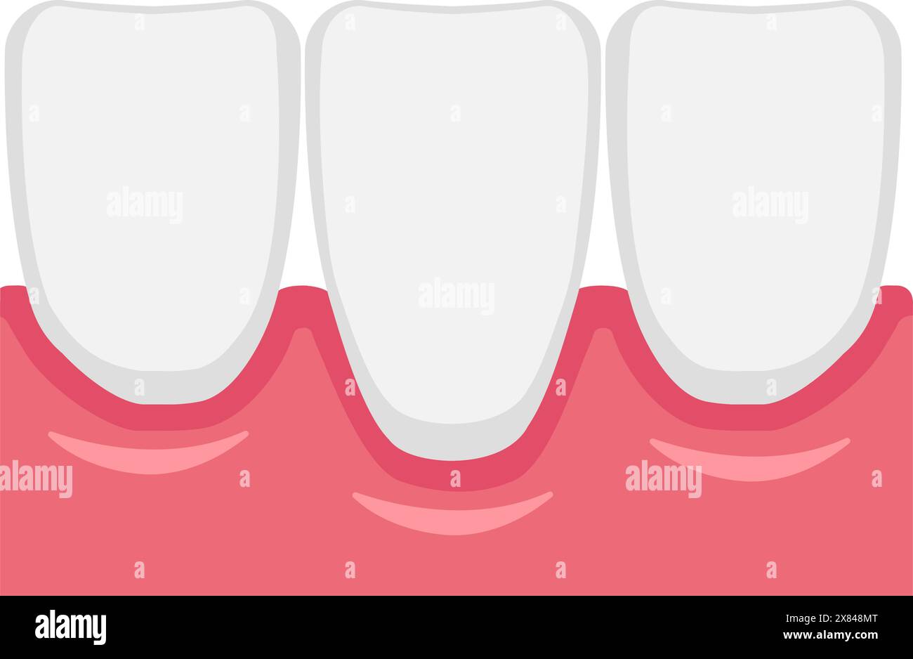 Illustration vectorielle de la récession gingivale Illustration de Vecteur