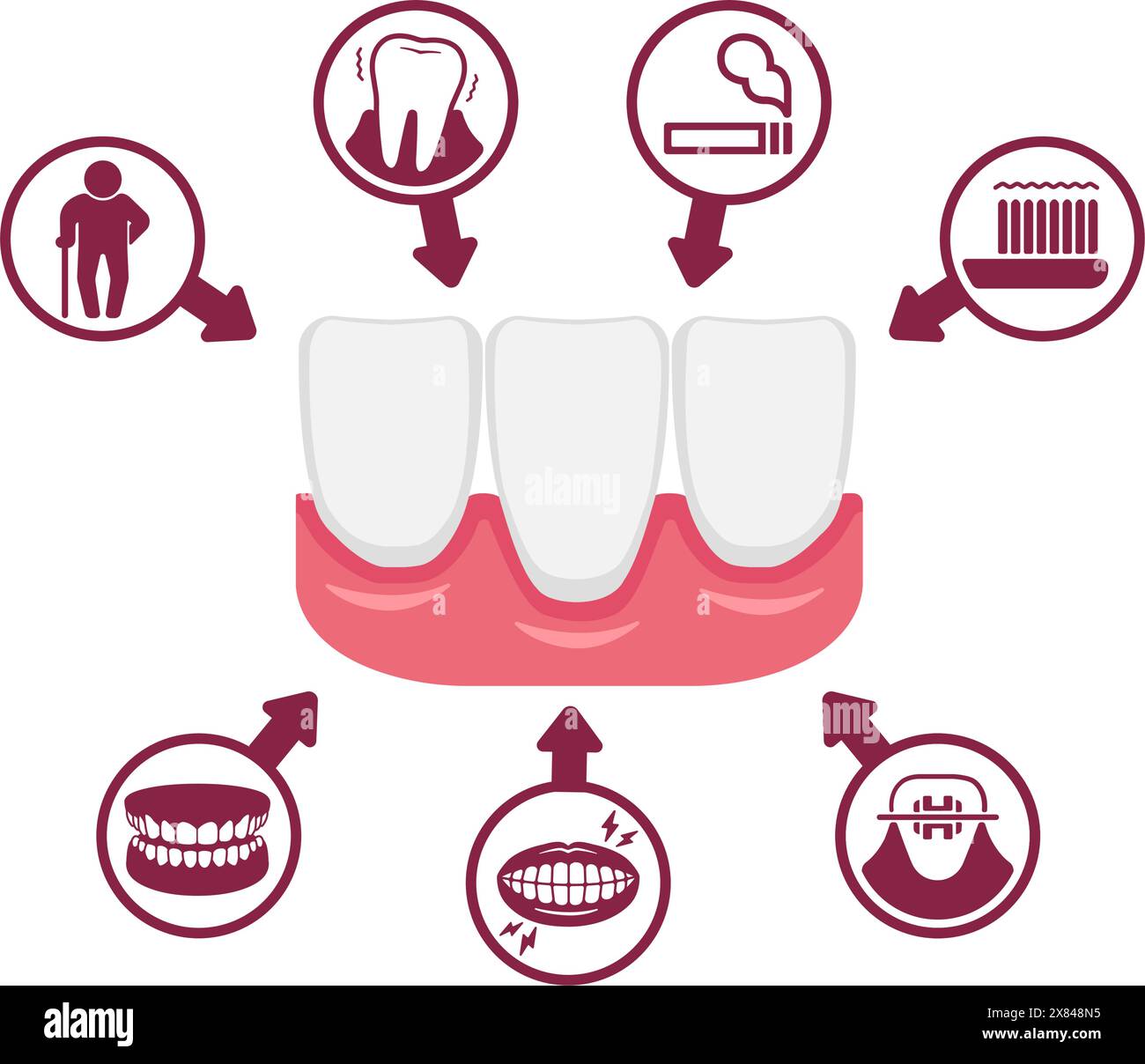 Causes de récession gingivale. Illustration vectorielle. Illustration de Vecteur