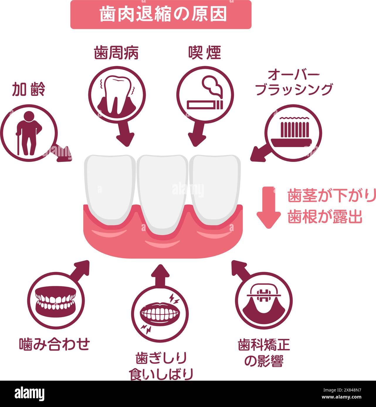 Causes de récession gingivale. Illustration vectorielle. Illustration de Vecteur