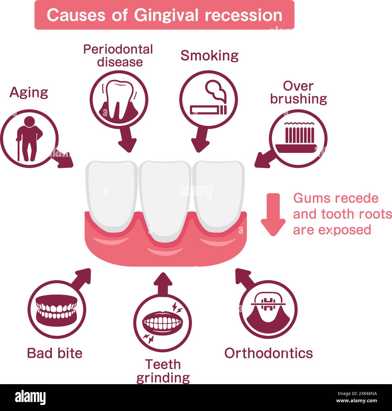 Causes de récession gingivale. Illustration vectorielle. Illustration de Vecteur