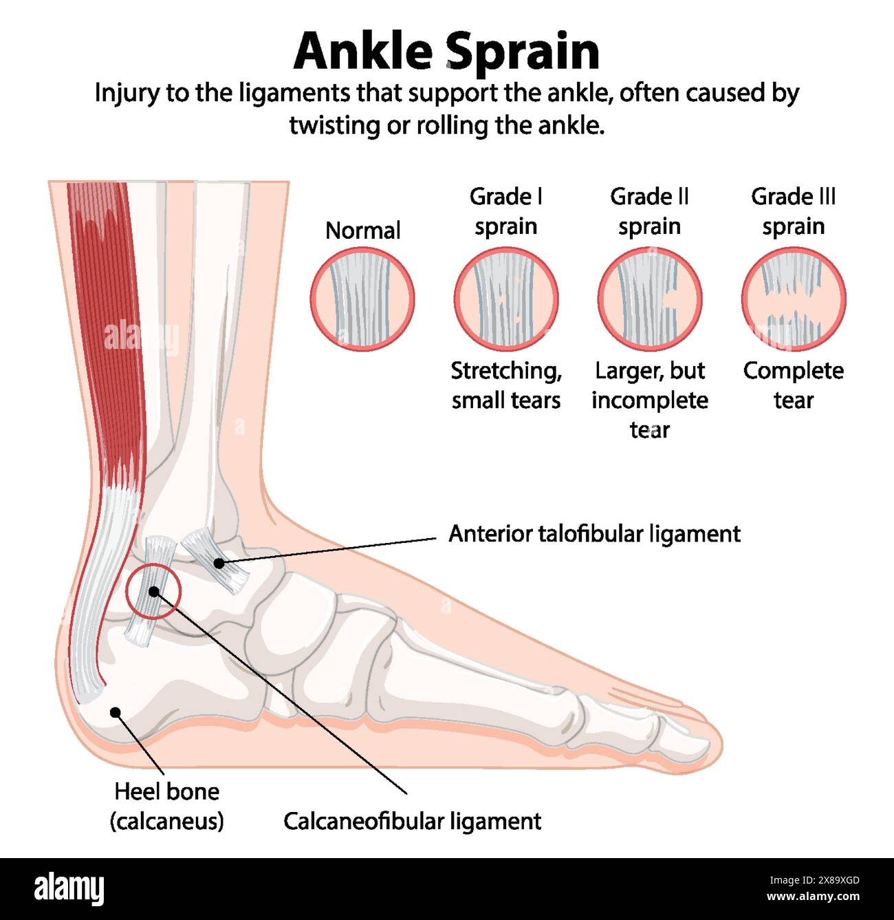 Schéma détaillé des types d'entorses de la cheville Illustration de Vecteur