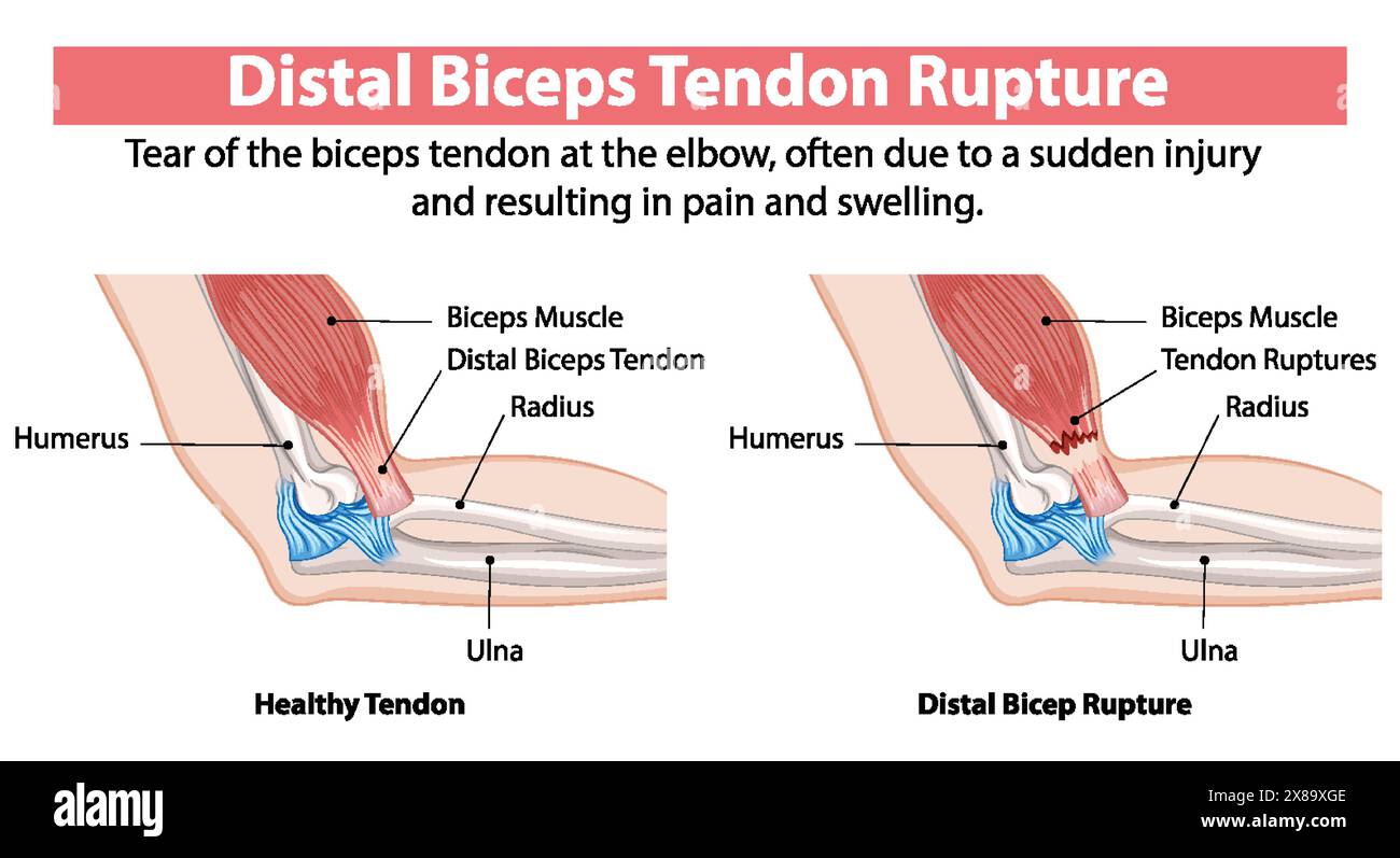 Comparaison du tendon sain et du tendon rompu du biceps Illustration de Vecteur